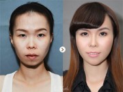 Làm đẹp - "Vịt hóa thiên nga" sau 3 lần phẫu thuật thẩm mỹ