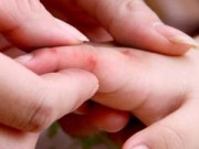 Tin tức - Hà Nội xuất hiện 5 ổ dịch tay chân miệng