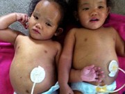 Làm mẹ - Cảnh éo le bố Canada hiến gan cứu con nuôi người Việt