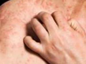 Bệnh chàm làm tăng nguy cơ bệnh tim, đột quỵ