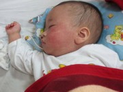 Tin tức - Dịch sởi tiếp tục lan rộng ở Mỹ và tranh cãi về vắc xin