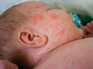 Lo dịch sởi bùng phát