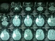 Tin tức - Câu chuyện cảm động của sản phụ bị xuất huyết não