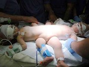 Làm mẹ - Khoảnh khắc kỳ diệu tách thành công 2 bé liền vùng kín