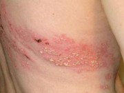 Sức khỏe - Triệu chứng và các biện pháp điều trị bệnh zona thần kinh