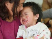 Làm mẹ - TQ: Hai trẻ loét miệng vì ăn quà vặt Trung Quốc