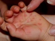 Sức khỏe - Biện pháp phòng chống bệnh chân tay miệng