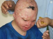 Tin tức - Cậu bé bỏng xăng toàn thân bây giờ ra sao?