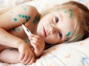 Sức khỏe - Bệnh thủy đậu cà cách điều trị nhanh khỏi, không để lại sẹo