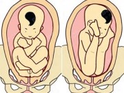 Bà bầu - Những kiểu ngôi thai khiến bác sĩ "đau đầu"