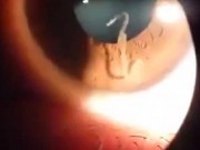Tin tức - Video: Kinh hãi giòi ngọ nguậy trong mắt bệnh nhân