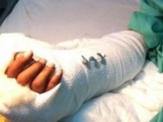 Tin tức - Chém người đứt gần lìa tay chì vì nhìn thấy ghét