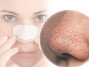Làm đẹp - 5 bước loại sạch mụn đầu đen đáng ghét khỏi làn da