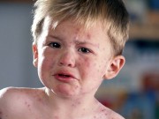 Làm mẹ - Bác sĩ tư vấn cách trị bệnh thủy đậu tại nhà cho bé