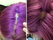 Làm đẹp - Cô gái Việt bị phồng rộp, tróc da đầu vì nhuộm tóc