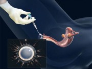 Tin tức - Bơm tinh trùng một cách thô sơ vẫn có thể thụ thai