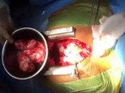 Tin tức - Phát hiện khối u chèn ép tim sau khi bị ho ra máu