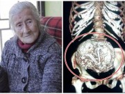 Bà bầu - Bà cụ 91 tuổi phát hiện thai nhi nằm 60 năm trong bụng