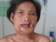 Tin tức - Phẫu thuật thành công ung thư môi dưới sùi to xâm lấn miệng