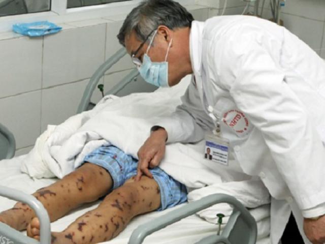 Xuất hiện ca nhiễm não mô cầu đầu tiên ở Hà Nội