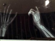 Tin tức - Bé trai 11 tuổi tự cắt ngón tay vì bị cấm dùng smartphone