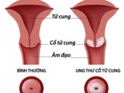 Tin tức - Ba ‘vũ khí’ tiêu diệt ung thư cổ tử cung ở phụ nữ