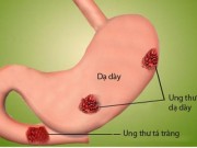 Tin tức - Những dấu hiệu ung thư đại trực tràng ai cũng bỏ qua