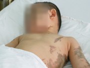 Tin tức - Nỗi đau hai mẹ con bị kẻ hận tình tạt axit