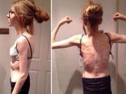 Làm đẹp - 'Nghiện' ăn kiêng, cô gái 15 tuổi chỉ còn da bọc xương