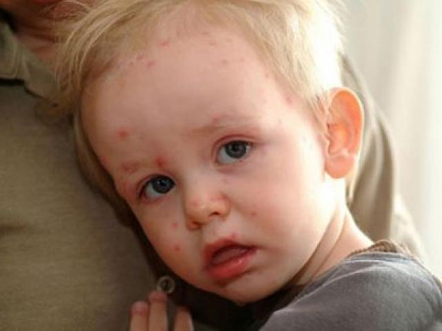 Những sai lầm tai hại khi điều trị bệnh thủy đậu