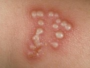 Sức khỏe - Những dấu hiệu của làn da cảnh báo bệnh tình dục nguy hiểm