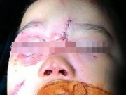 Tin tức - Cứu sống bé trai 3 tuổi bị chó cắn nát mắt, rách võng mạc