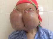 Tin tức - Bệnh nhân có khối u khổng lồ trên mặt đã được phẫu thuật