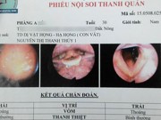 Tin tức - Đỉa ngọ nguậy trong họng một nam thanh niên
