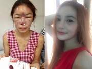 Làm đẹp - Cô gái suýt phải cắt bỏ mũi vì phẫu thuật thẩm mỹ hỏng