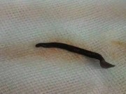 Tin tức - Chảy máu liên tục do đỉa dài 4,5cm cư trú trong mũi