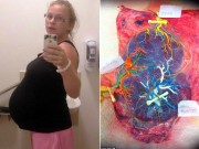 Bà bầu - "Sốc" với hình ảnh nhau thai bất thường của mẹ sinh ba