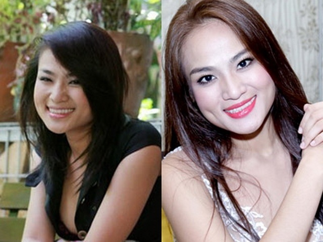 Duyên Anh Idol cười đơ sau khi tiêm botox