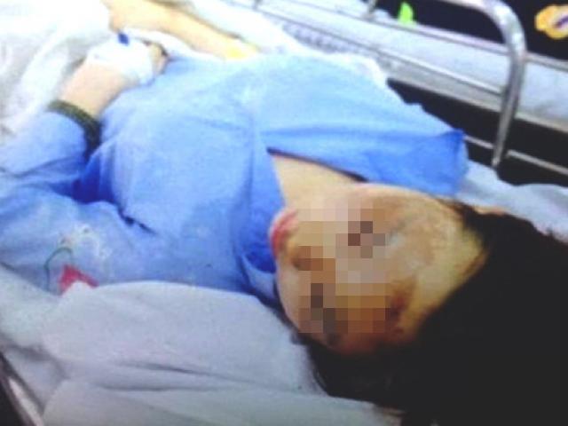 Nỗi đau mang tên axit còn sợ hơn cả cái chết...