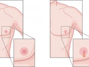 Tin tức - Đa số nam giới phát hiện ung thư vú khi đã quá muộn