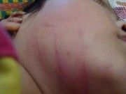 Tin tức - Nghi án cô giáo mầm non đánh trẻ bầm mặt