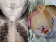 Làm mẹ - Suýt mất con chỉ vì thấy trẻ ho liên tục mà không khám