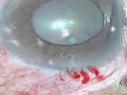 Tin tức - Kỳ lạ: Con giun đũa chó sống trong mắt người phụ nữ