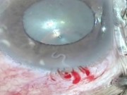 Sức khỏe - Kỳ lạ: Con giun đũa chó sống trong mắt người phụ nữ