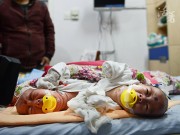 Làm mẹ - Xúc động khoảnh khắc hai bé sơ sinh dính liền được tách rời