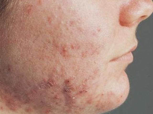 Cách xử lý khi bị viêm da cơ địa