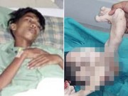 Bà bầu - Kinh hoàng thai nhi nằm trong bụng chàng trai suốt 15 năm