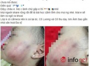 Tin tức - Bé 17 tháng tuổi thâm tím mặt: Trần tình của cô giáo