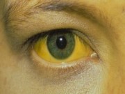 Tin tức - TP. HCM: Cẩn thận muỗi vằn đốt gây bệnh sốt vàng