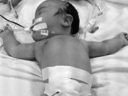 Bà bầu - Xót lòng những em bé sơ sinh có nội tạng nằm ngoài cơ thể